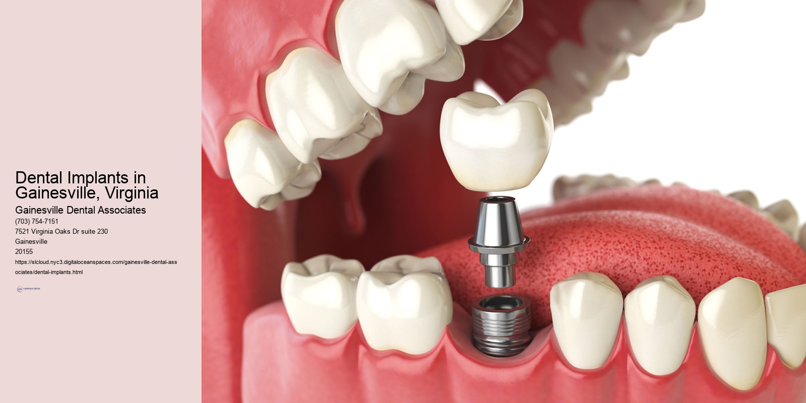 Dental Implants in Gainesville, Virginia